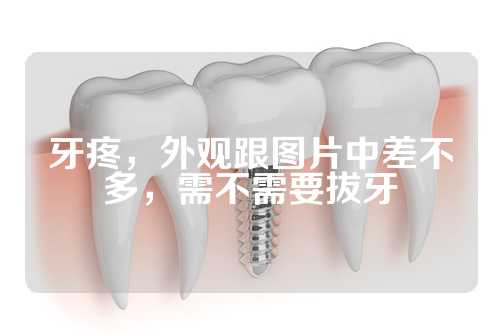 牙疼，外观跟图片中差不多，需不需要拔牙