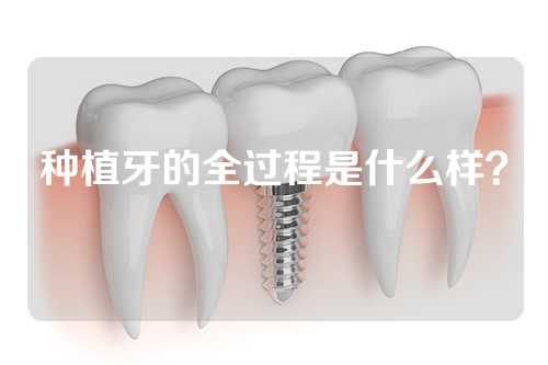 种植牙的全过程是什么样？